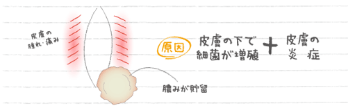 バルトリン