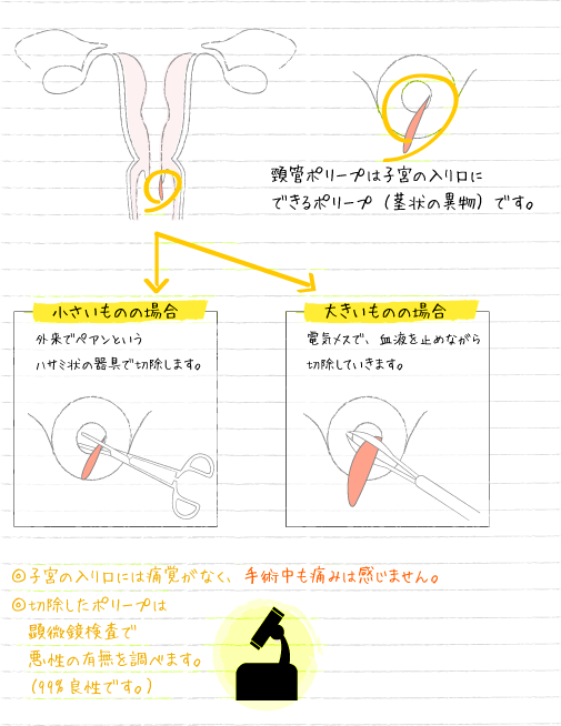 頸管ポリープ切除術